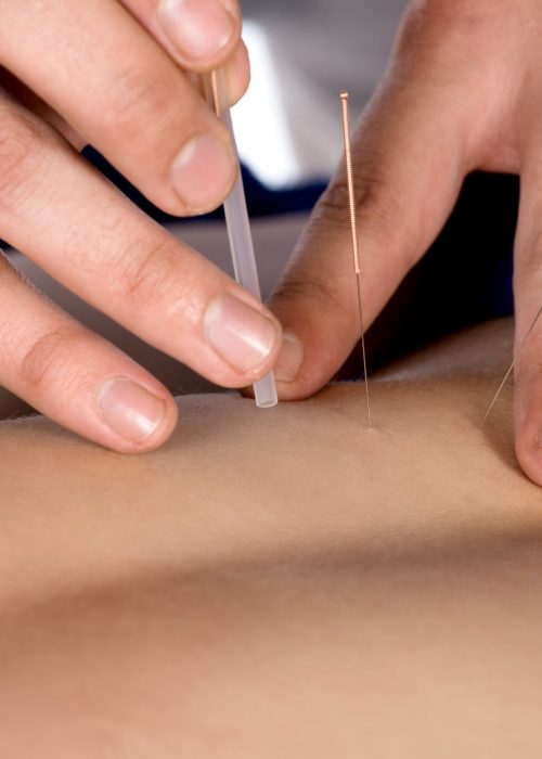 Acupuncture